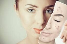 Botox keitimas